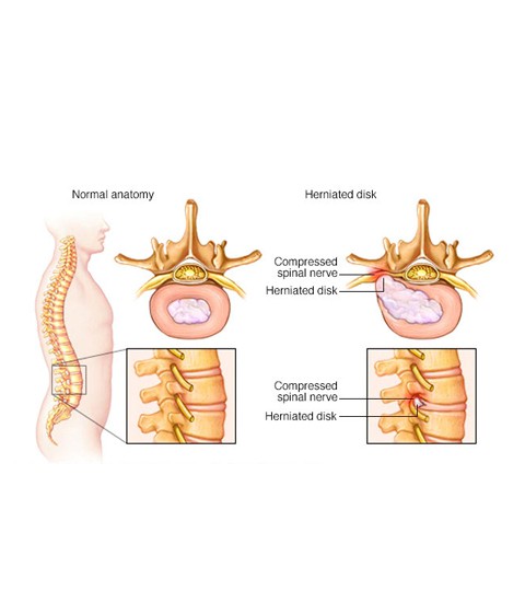 Aqua Lase (15 W/1470nm)